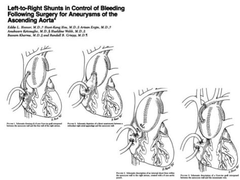 Revisiting bentall procedure