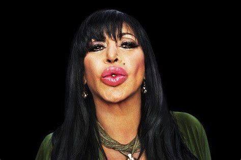 Top 5 Bad Lip Injections Before And After Photos | Bad lip injections, Lip injections, Big ang