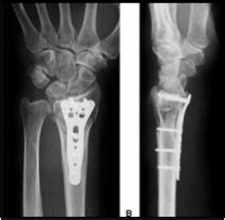 Distal Radius Fracture - GC Hand Therapy