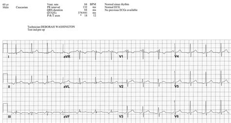 Atrial Rhythm