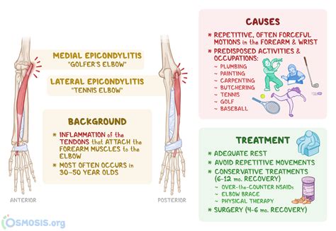 Epicondylitis: What Is It, Causes, Treatment, and More