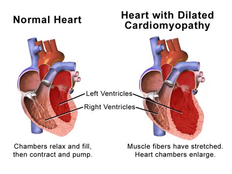 Cardiomyopathy - almostadoctor