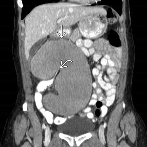 Cecal Volvulus | Radiology Key