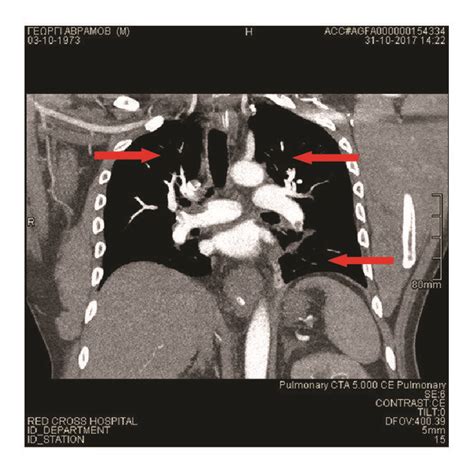 Chest CT angiography scan, depicting filling defects in subsegmental ...