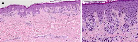 Dysplastic Nevi Versus Melanoma | Basicmedical Key