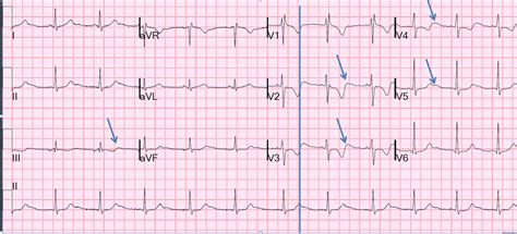 Dr. Smith's ECG Blog: A woman in her 20s with syncope