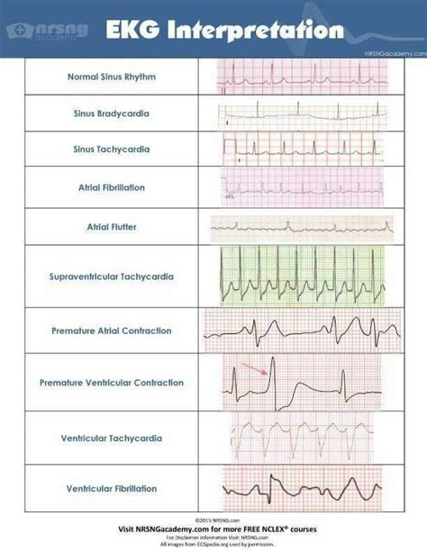 Ekg interpretation | Nursing school, Nursing school survival, Ekg ...