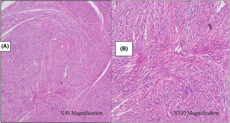 Unusual case of broad ligament leiomyoma: A diagnostic and surgical ...