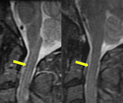 Gibbs artifact? - Questions and Answers in MRI