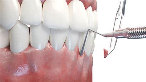 When is a Gum Graft Recommended? - Brighton Periodontal & Implant ...