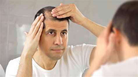 Hair Loss Treatment In Nepal | Causes, Types & Treatment