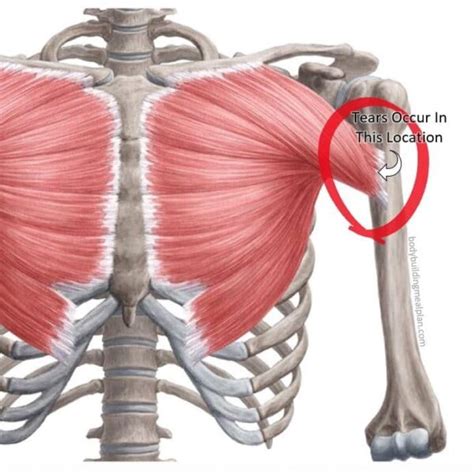 Torn Pectoral Muscle: Treatment, Recovery, Before & After Pictures