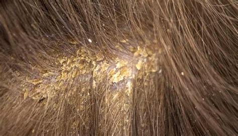 How To Treat Scabs On The Scalp - lifeberrys.com