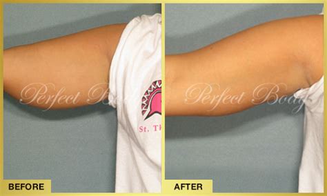 Perfect Body Laser Fat Reduction for Arms -- Perfect Body Laser & Aesthetics | PRLog