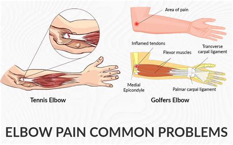 Elbow Pain Common Problems - Dr. Saurabh Aggarwal