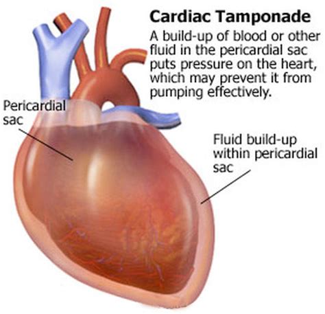 Acute cardiac tamponade