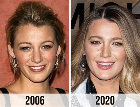 Blake Lively Nose Job And Plastic Surgery Before And After - WeBlogy