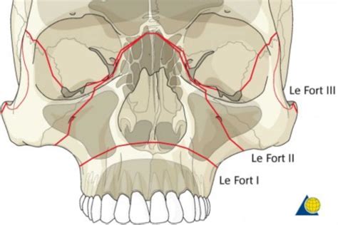 A Dental Student's Guide to...Le Fort fractures - Dentistry