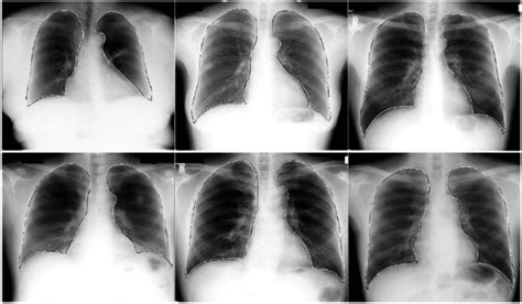 Viral pneumonia chest x ray findings - looksrat