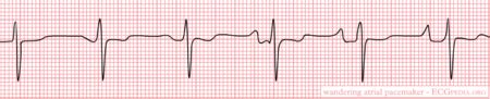 Wandering Pacemaker - ECGpedia