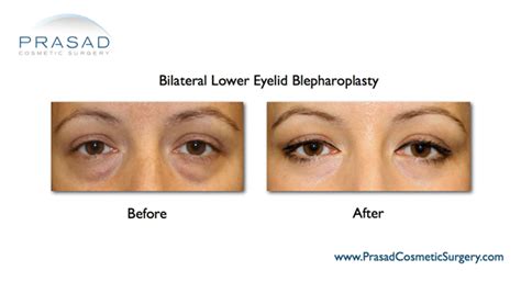 Eye Bag Surgery with Fast Recovery - New York City and Garden City, NY