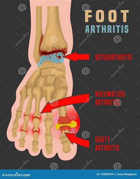 Arthritis Infographic Poster Vector Illustration | CartoonDealer.com #160052850