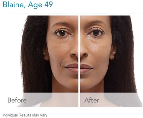 Radiesse Dermal Filler Can Help Fill In Laugh Line Wrinkles | Las Vegas NV