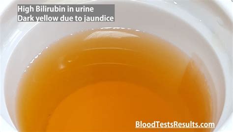 dark yellow urine | Urinal, Bilirubin levels, Dark yellow