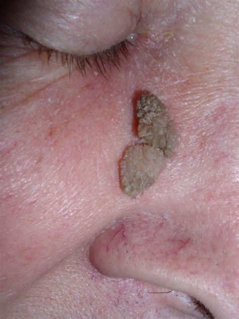 File:Papilloma skin.jpg - Wikimedia Commons