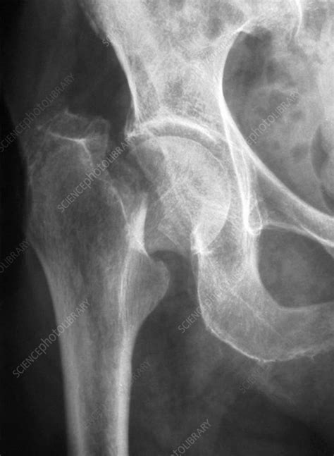 Fractured osteoporotic hip, X-ray - Stock Image - C022/6837 - Science Photo Library