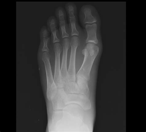 Cuneiform Bone Fracture