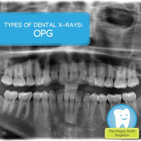 Types of dental x-rays – OPG | The Happy Tooth Singleton