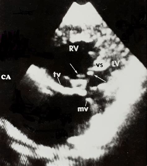 The cross sectional 2 D echocardiogram in a child with Ellis-Van-Creved... | Download Scientific ...