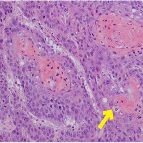 c. High power view of keratin pearls characteristic of squamous cell... | Download Scientific ...