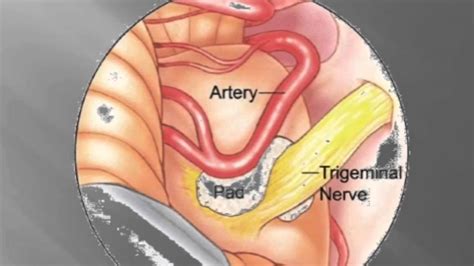 Trigeminal Neuralgia Disorder with Microvascular Decompress - YouTube