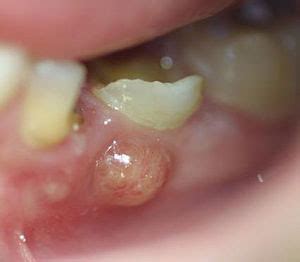 Abscess (Acute a) - Definition of Abscess (Acute a)