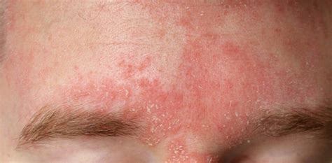 Skin Conditions/Dermatitis | Acne Concern