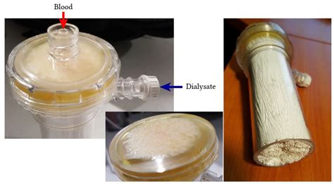 Physical and chemical characteristics of dialysis membranes | Deranged Physiology