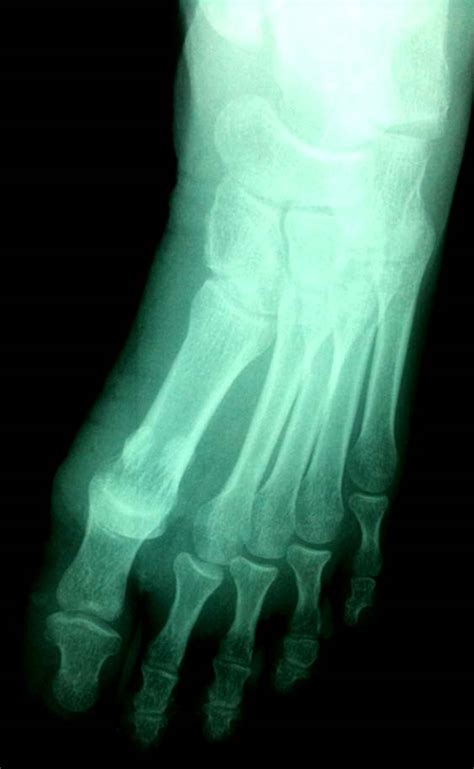 Plantar Dislocation of the First Metatarsophalangeal Joint