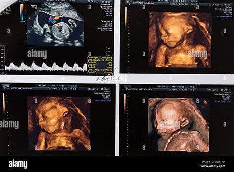 3D ultrasound of the 2nd trimester of a fetus Stock Photo - Alamy