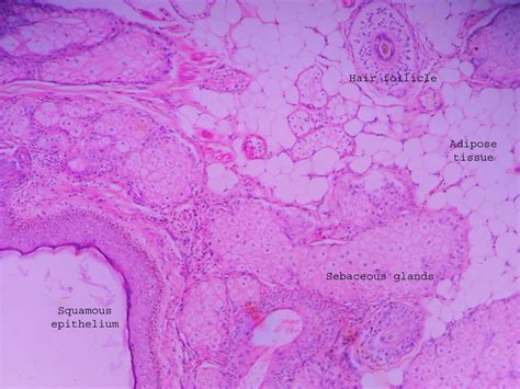 Dermoid cyst – ovary – Histopathology.guru