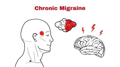 Causes of Chronic Migraine ~ Statcardiologist