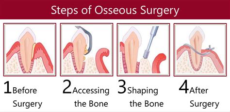 Osseous Surgery Procedure & Recovery Birmingham, AL - Periodontist in ...