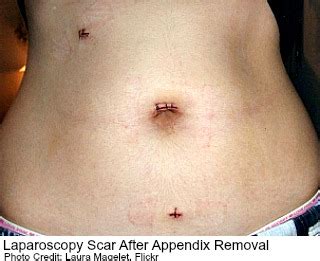 Laparoscopy Pictures