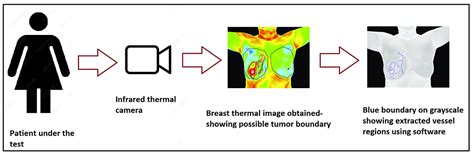 Thermography as a Breast Cancer Screening Technique: A Review Article | Cureus