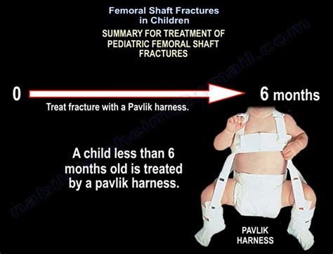 Femoral Shaft Fractures in Children — OrthopaedicPrinciples.com