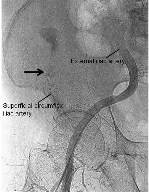 Lateral abdominal wall hematoma as a rare complication after carotid artery stenting: a case ...