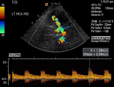 Imaging in Acute Stroke - The Western Journal of Emergency Medicine