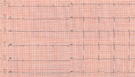 An Approach to Bradycardia in the Emergency Department - emdocs