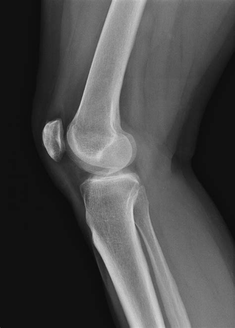 NORMAL KNEE 2 | Buyxraysonline